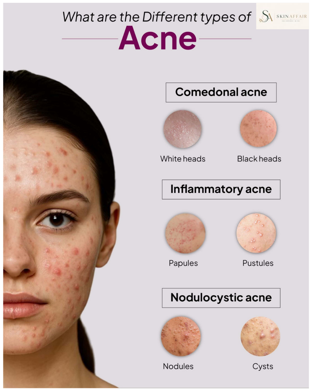 Best Skincare Routine for Acne-Prone Skin